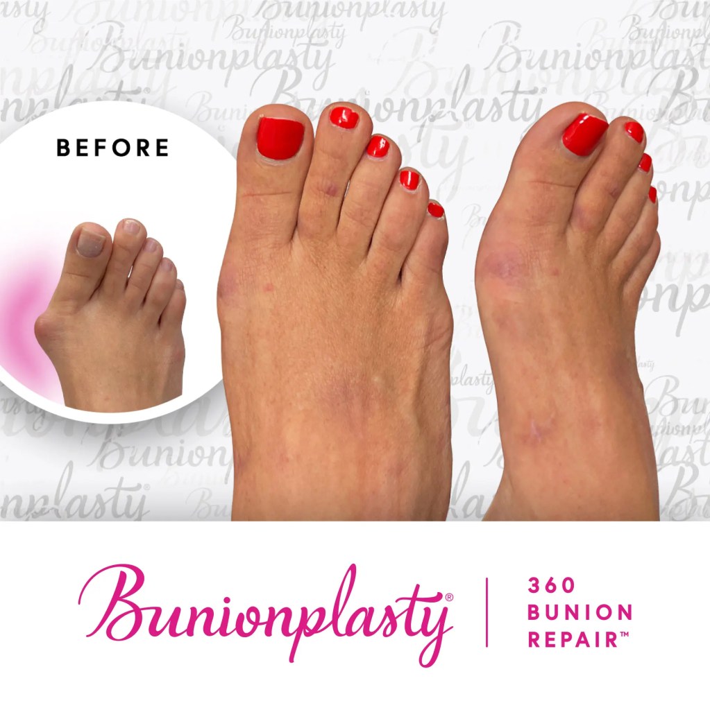 Photo showing feet before and after bunion surgery. Text reads "Bunionplasty 360 Bunion Repair.