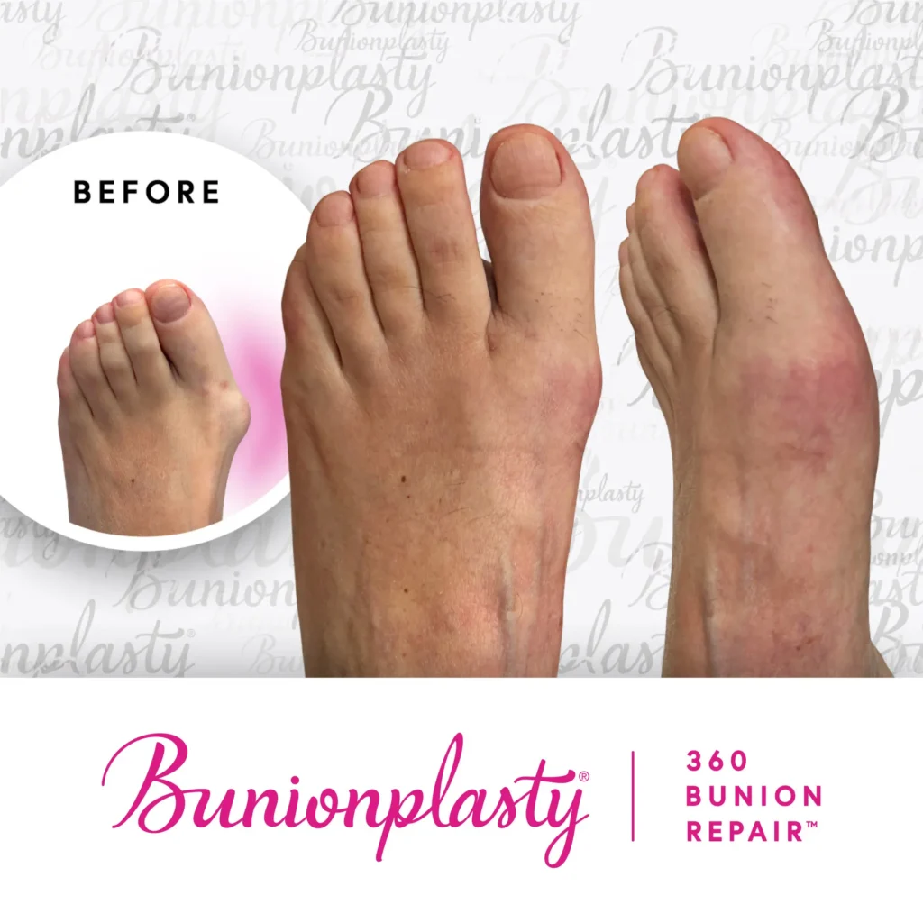 A pair of feet showing a before-and-after comparison of bunion surgery.