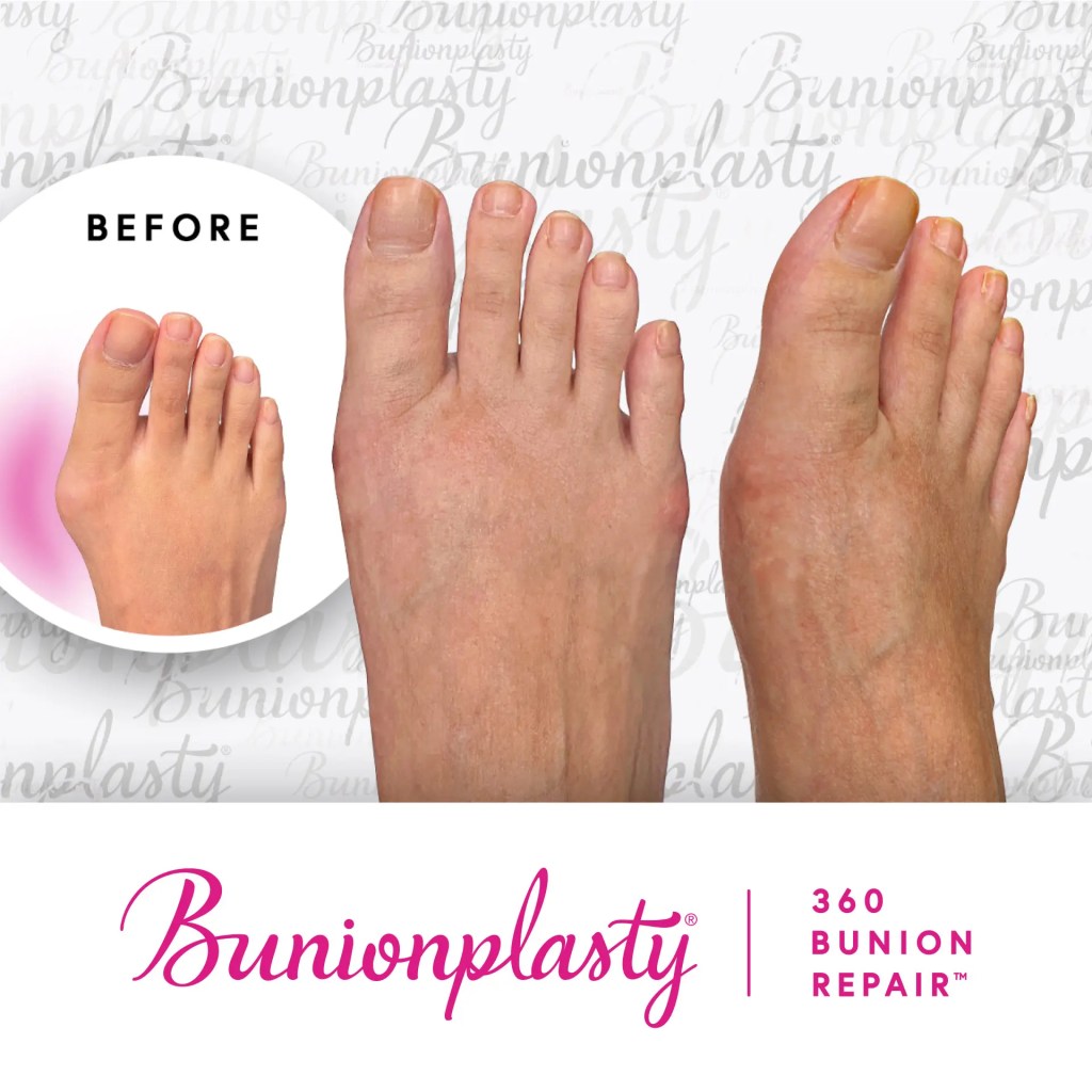 A close-up comparison of a foot before and after bunion surgery, showing correction of the big toe.